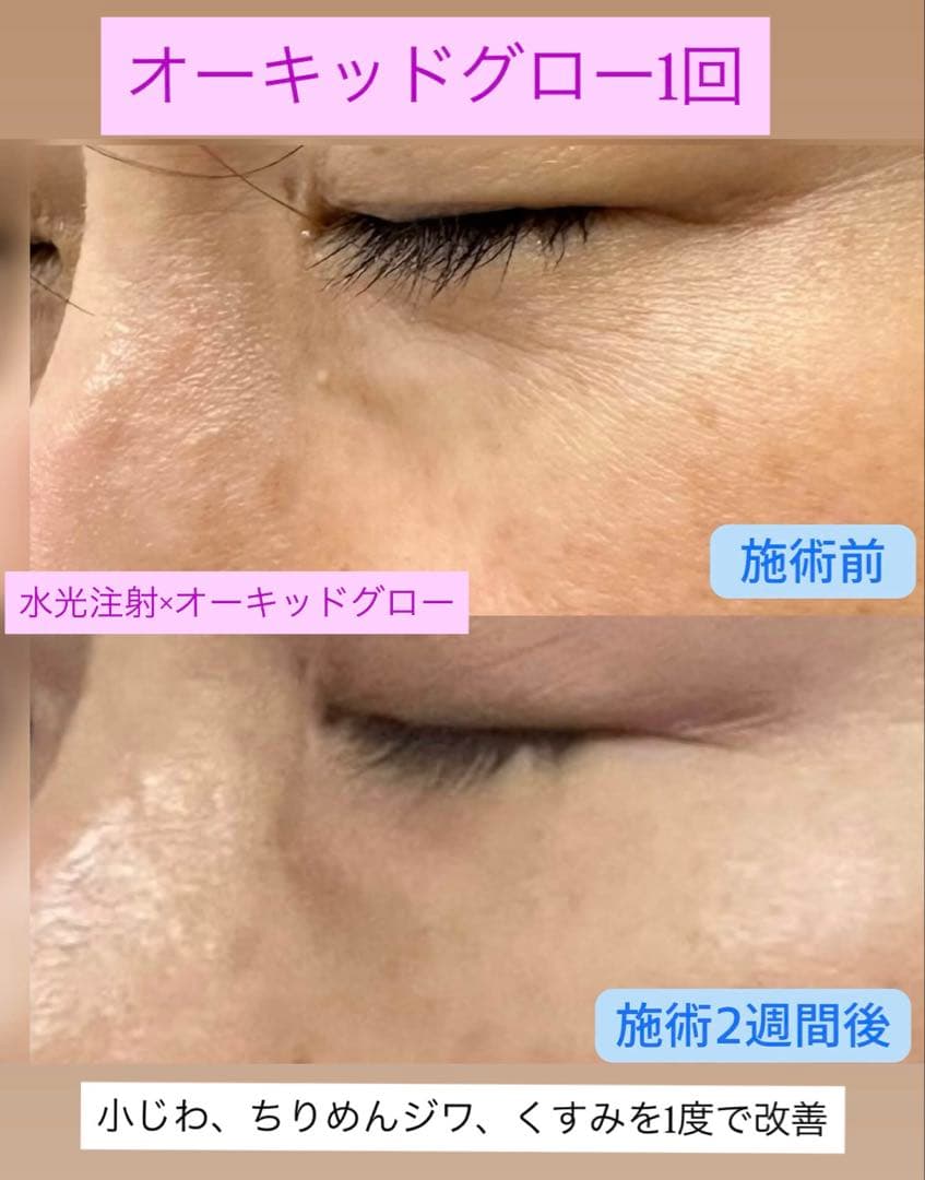 ひとみ　オーキッドグロー、水光スタンプ